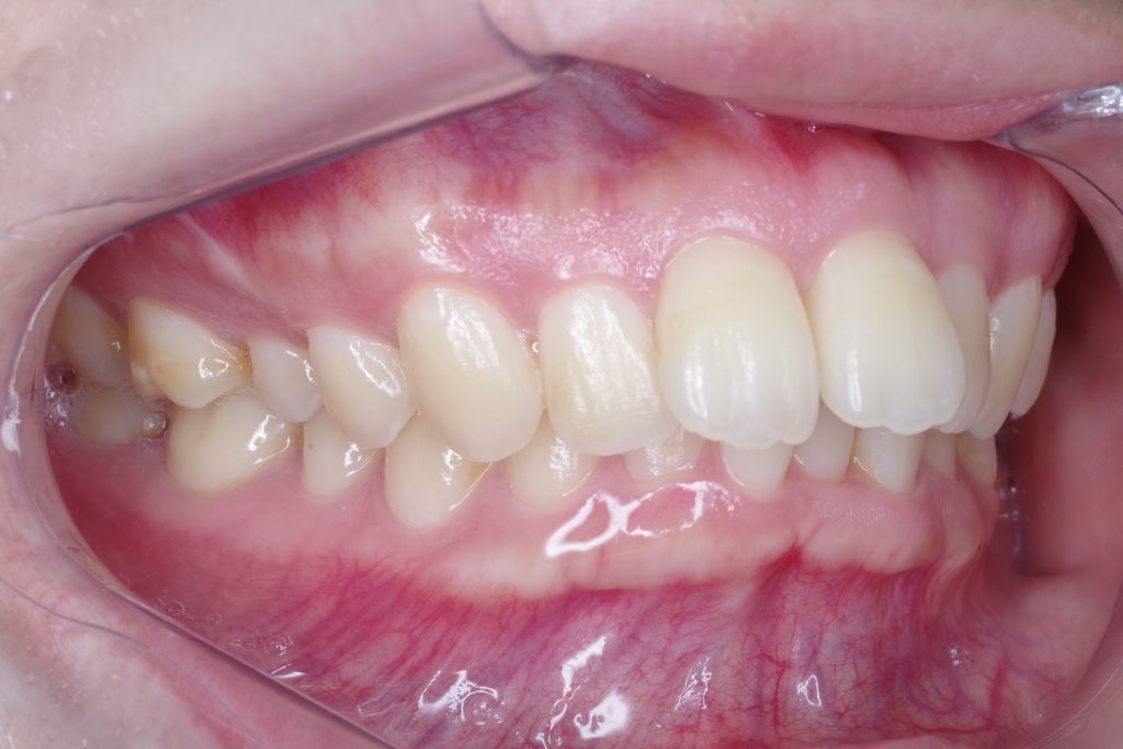 セラミック治療前の前歯左側