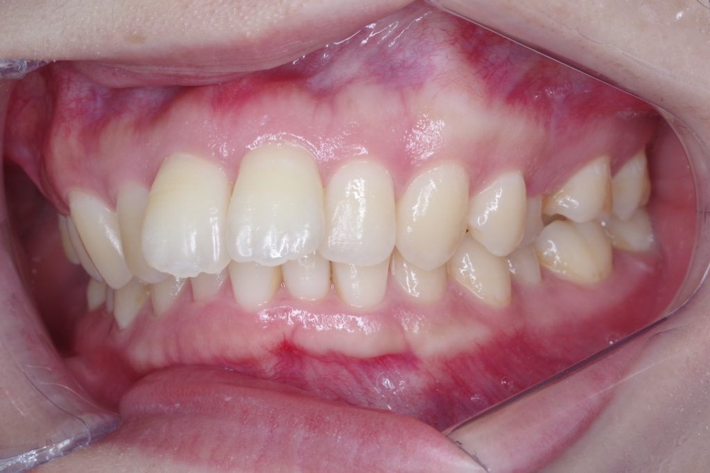 セラミック治療前の前歯右側