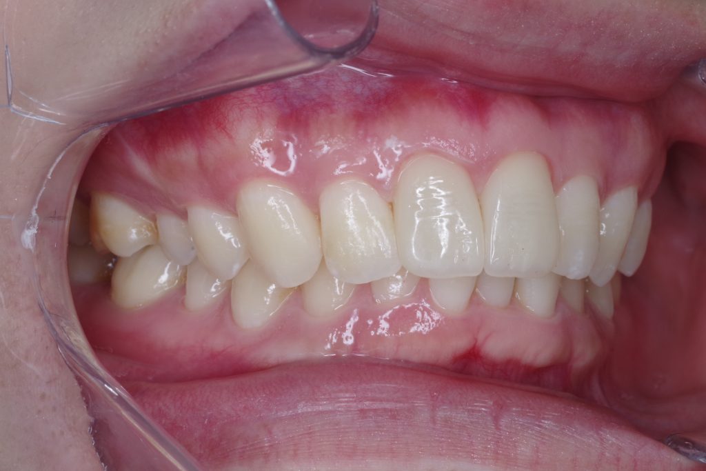 セラミック治療後の前歯右側