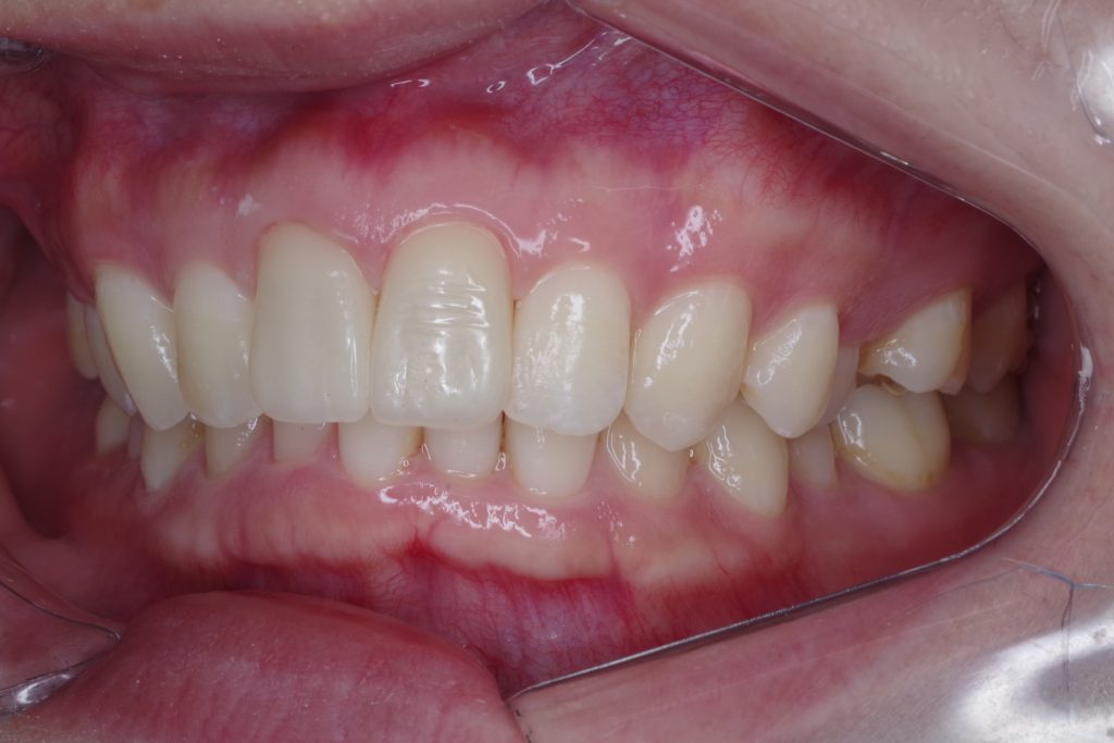 セラミック治療後の前歯左側