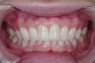 セラミック治療後の前歯正面