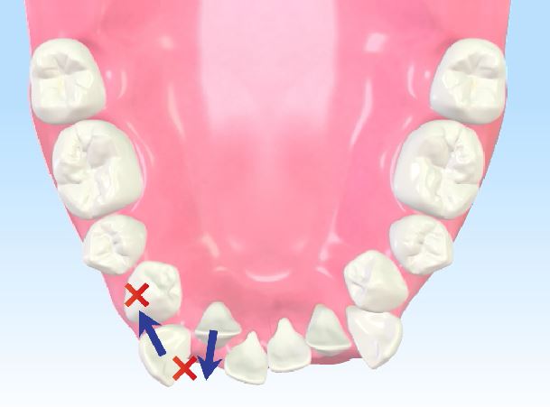 矯正治療で抜歯する歯を検討する