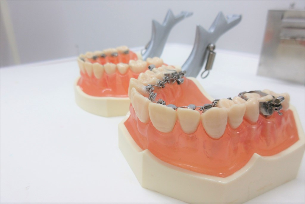 歯科医師が解説 矯正治療の種類と費用・相場について｜札幌市中央区