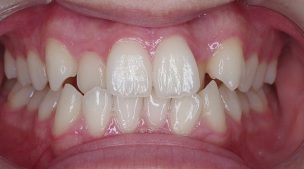 矯正治療を行う前の歯並び