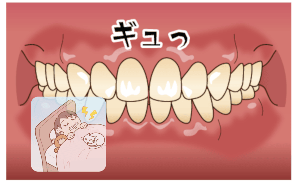 マウスピース矯正における歯ぎしりや食いしばりの影響について