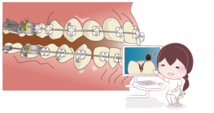 矯正治療と虫歯の説明をする歯科医